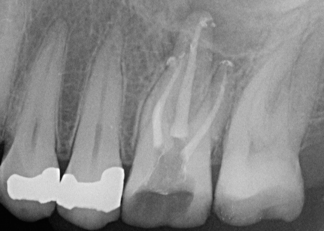 Les Ciments d'Obturation Endodontique