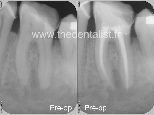 Tendinite endodontique