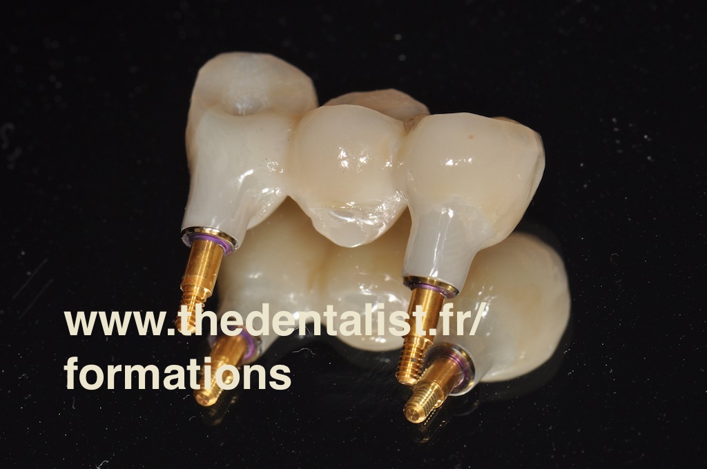 Actualit s De La Zircone The Dentalist Actualit s De La Zircone The Dentalist